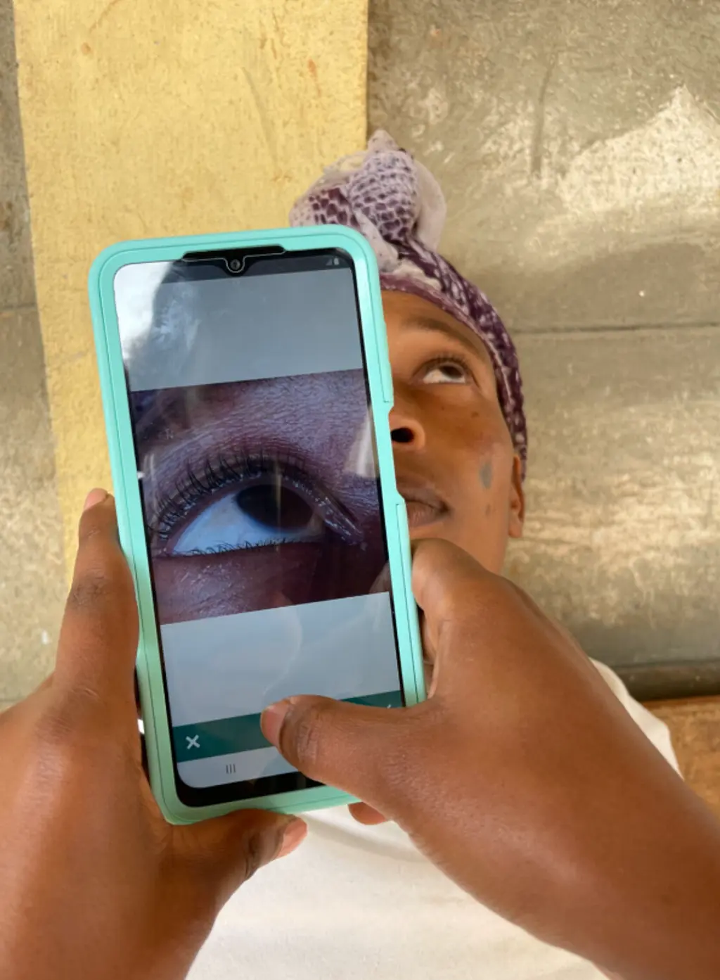 Using the classifeye app to check for signs of trachoma in Ethiopia