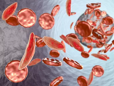 image showing sickle cell disease