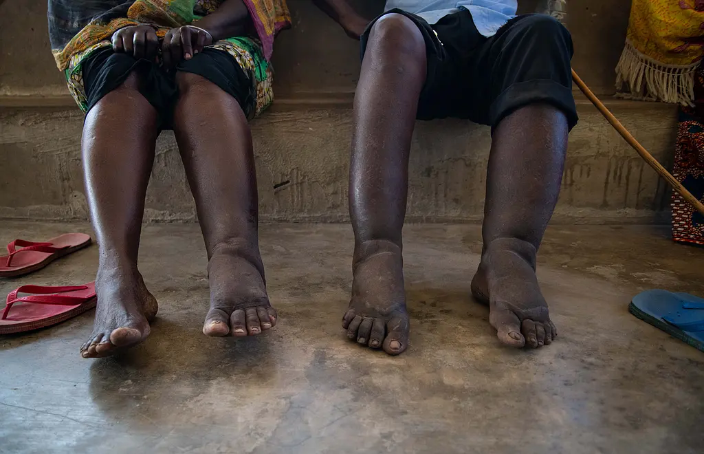 Two patients visit a health center for care for elephantiasis caused by lymphatic filariasis